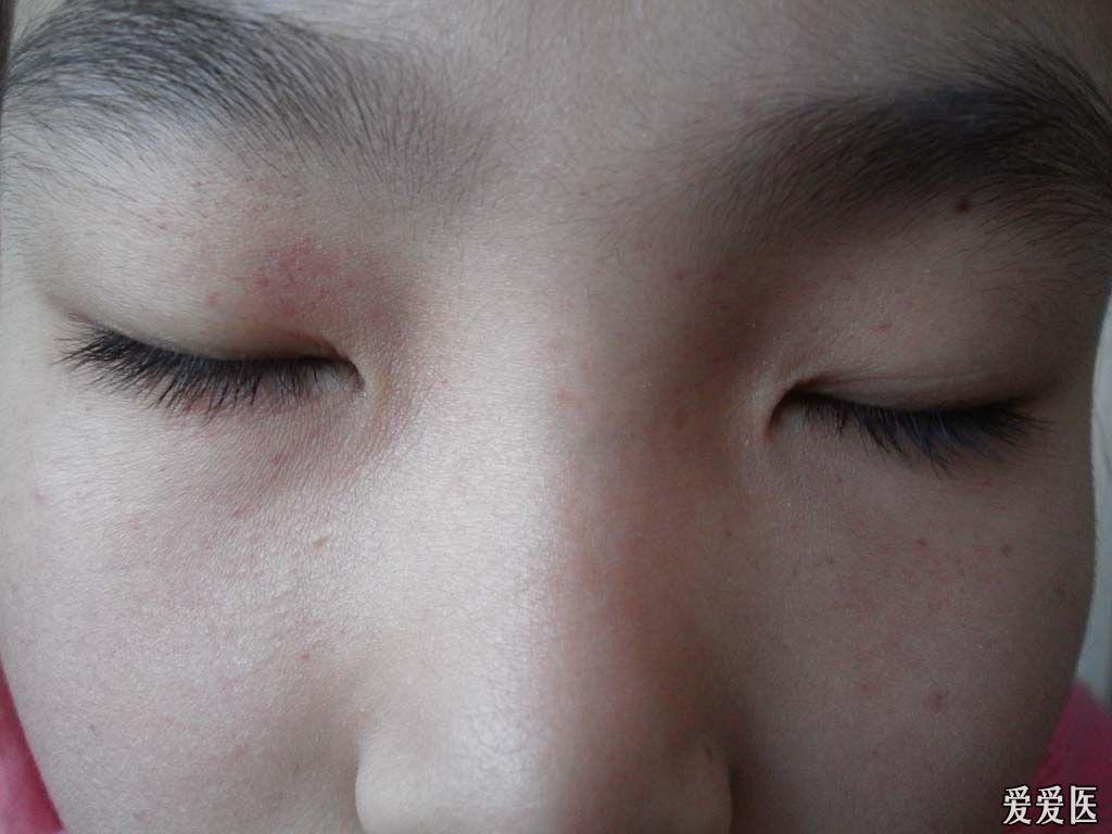 典型病例:压力性紫癜.
