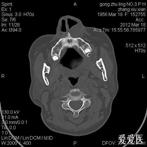 鼻前庭囊肿揭盖图片