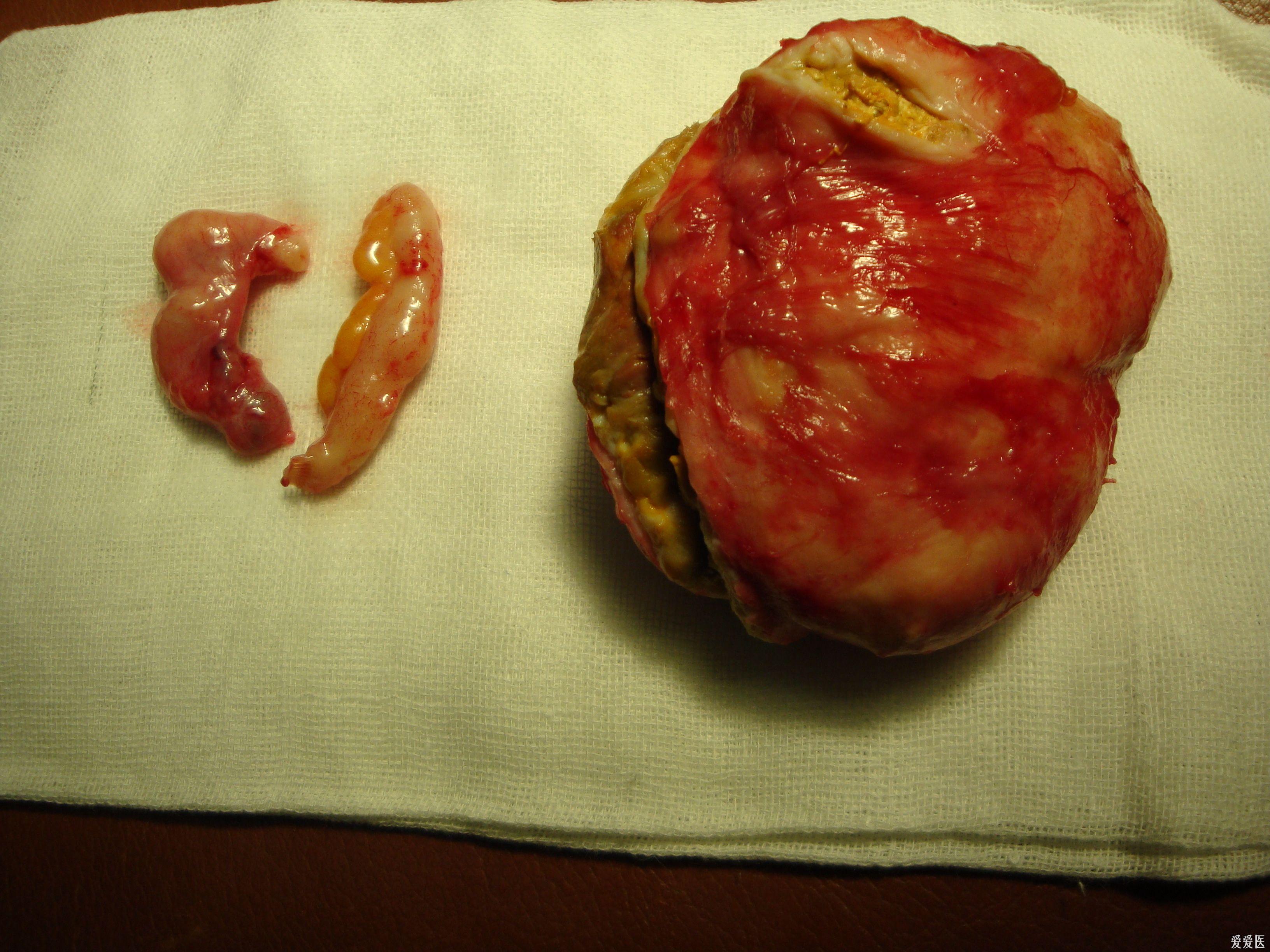 一例阑尾炎手术探查发现右侧附件包块