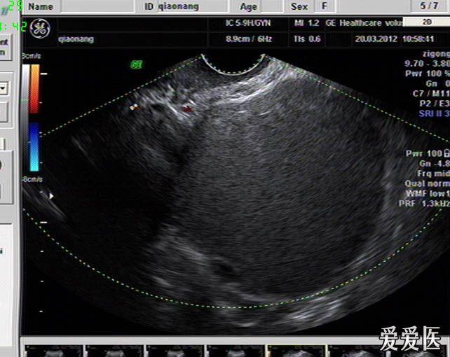 巧克力囊肿 超声图片