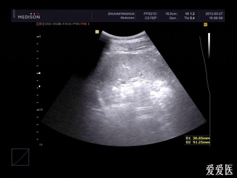 脾臟厚度:36.85mm,脾長度:91.25mm,形態正常,包膜光滑,實質回聲均勻.