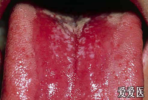 奇a组病毒引起,好发于夏秋季,疱疹主要发生在咽鄂弓,悬雍垂和软腭等处