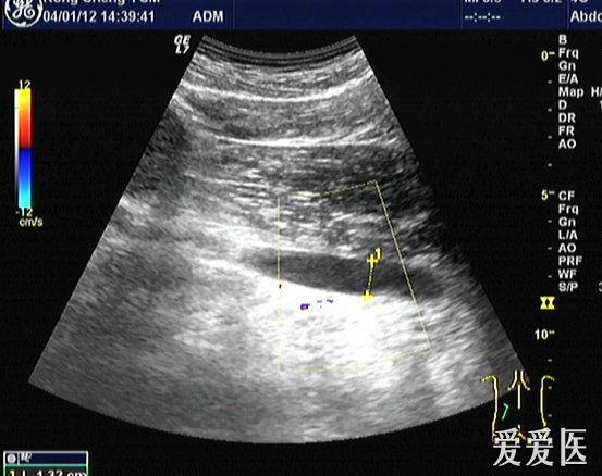 输尿管狭窄超声图片