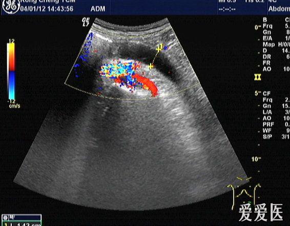 输尿管狭窄超声图片