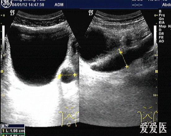 输尿管狭窄超声图片