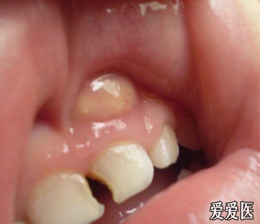 牙龈肿物图片