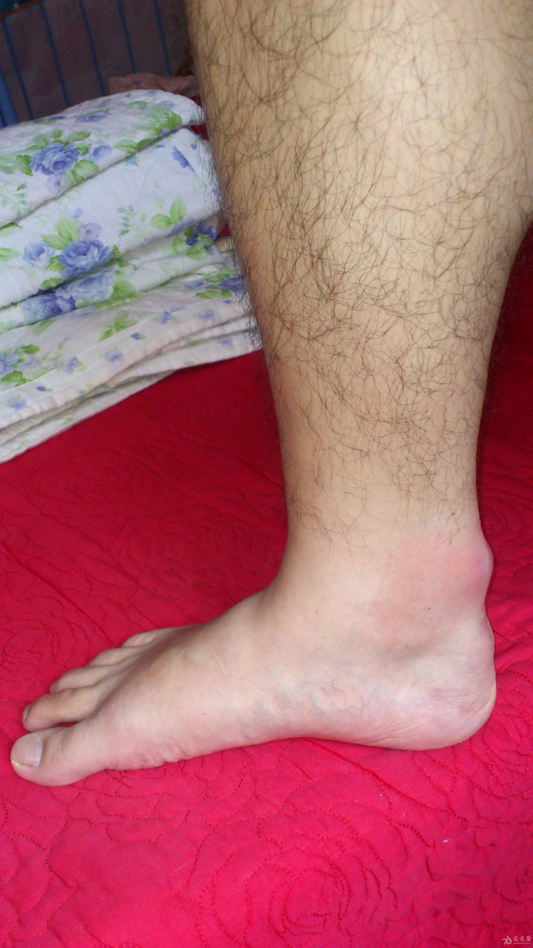 脚跟跟腱炎的症状图片图片