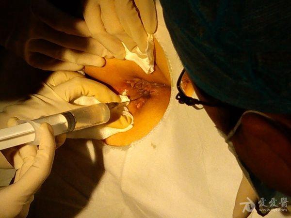 微创肛瘘手术刀口图片图片