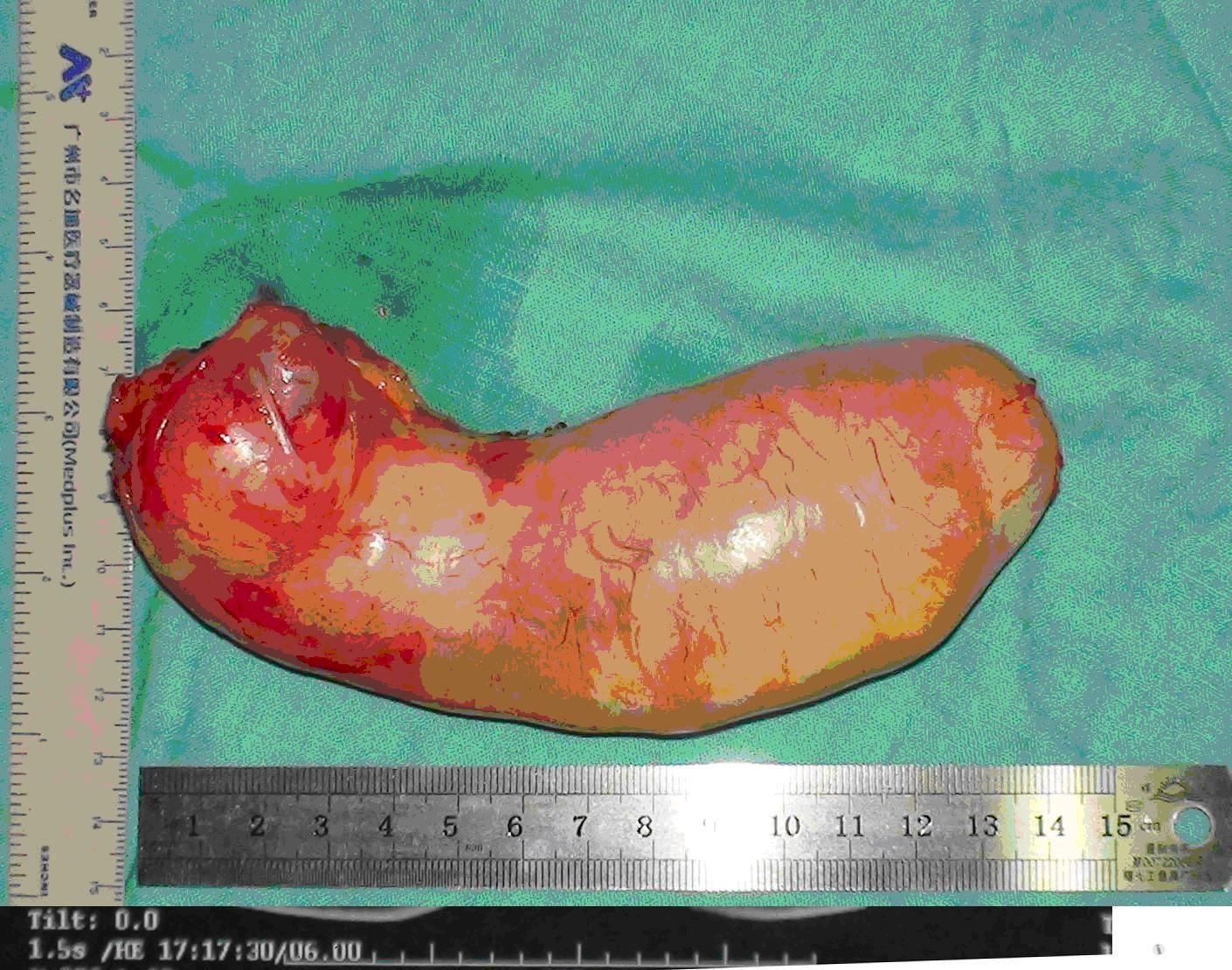 粘液腺瘤图片