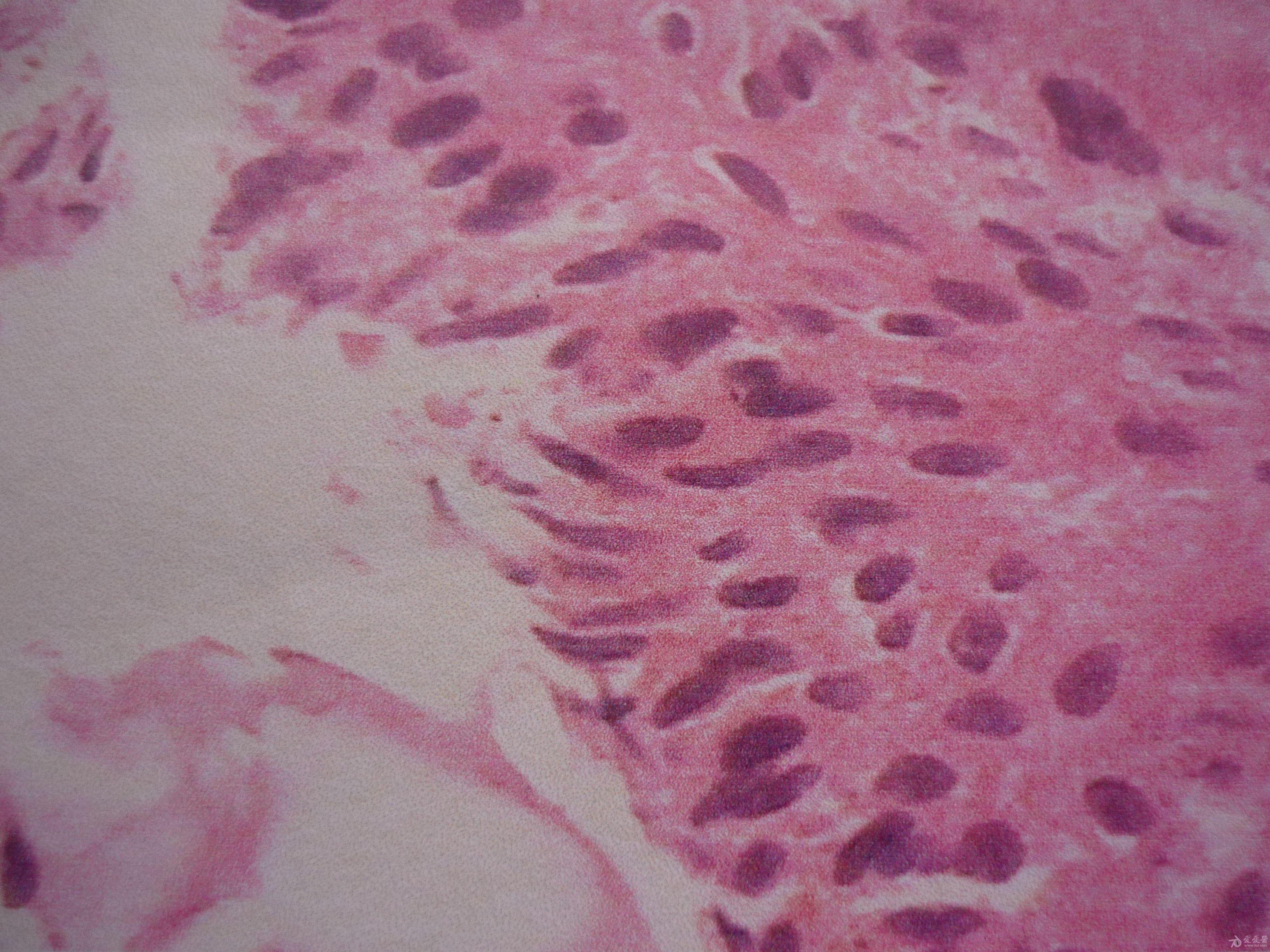 典型病例——阴茎中线囊肿