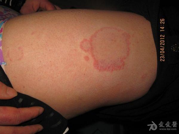 病例分享--------------------离心性环状红斑