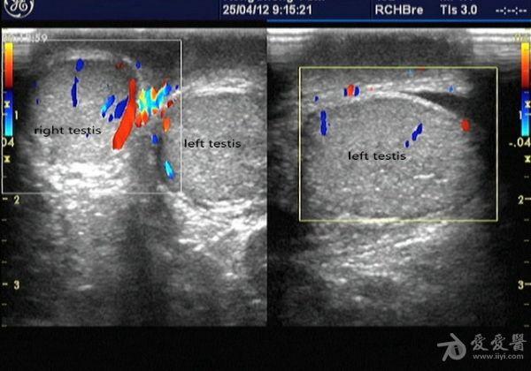 左側睪丸附件扭轉一例 - 超聲醫學討論版 - 愛愛醫醫學論壇 - 愛愛醫