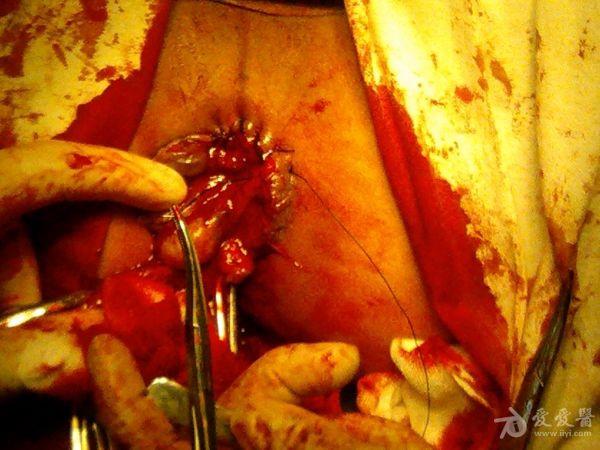 血栓性外痔剥离术图片