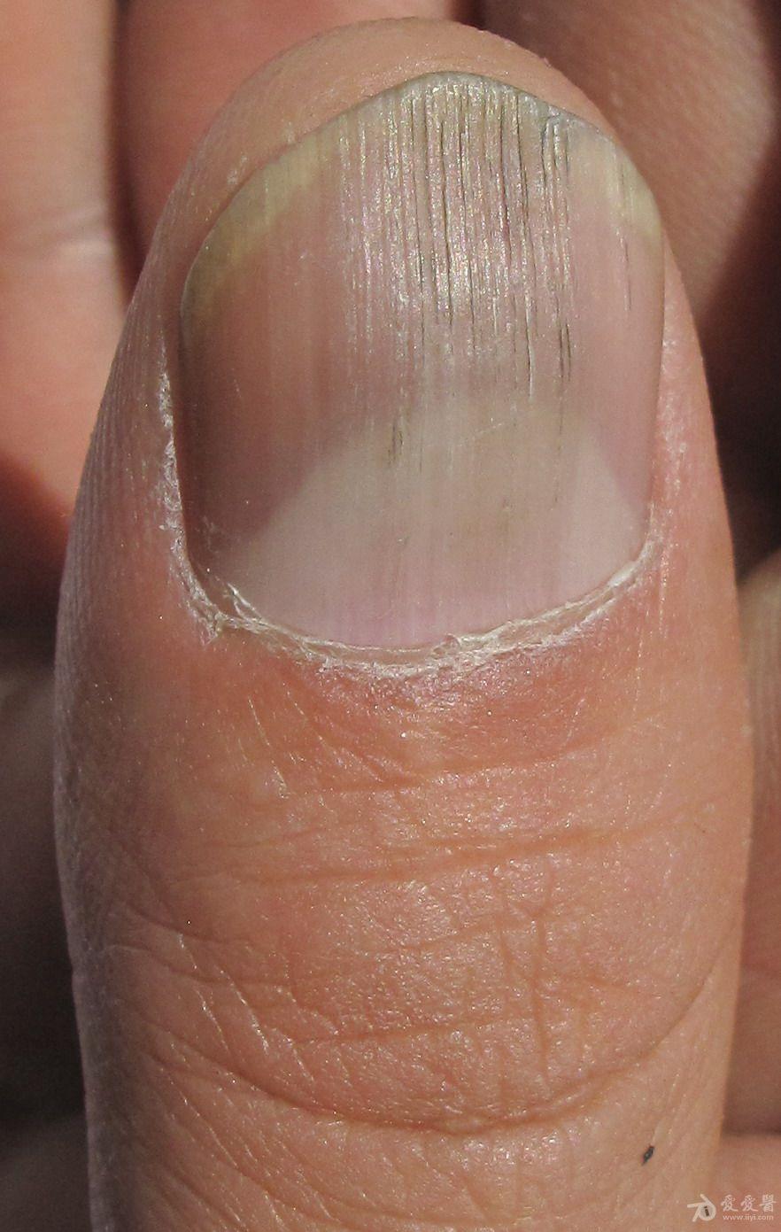 手指甲裂痕图片图片