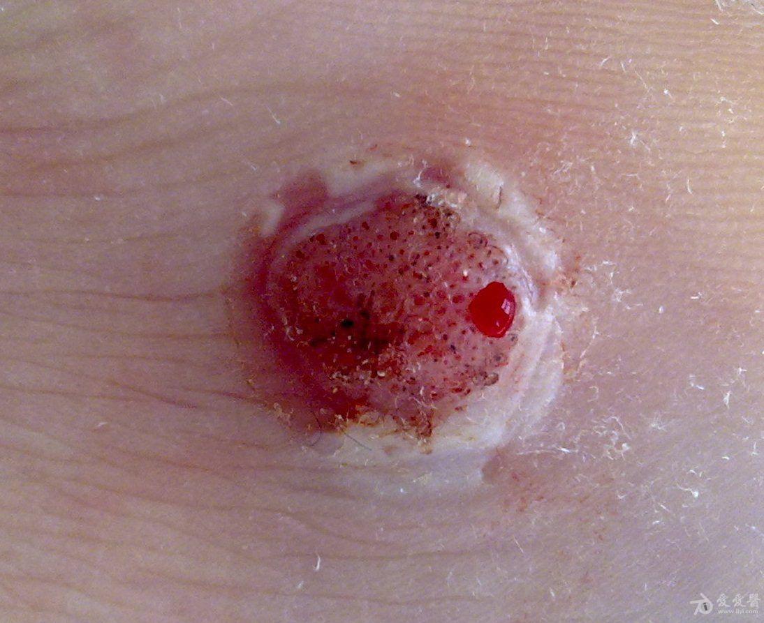 帮我看看这个寻常疣应该怎么治