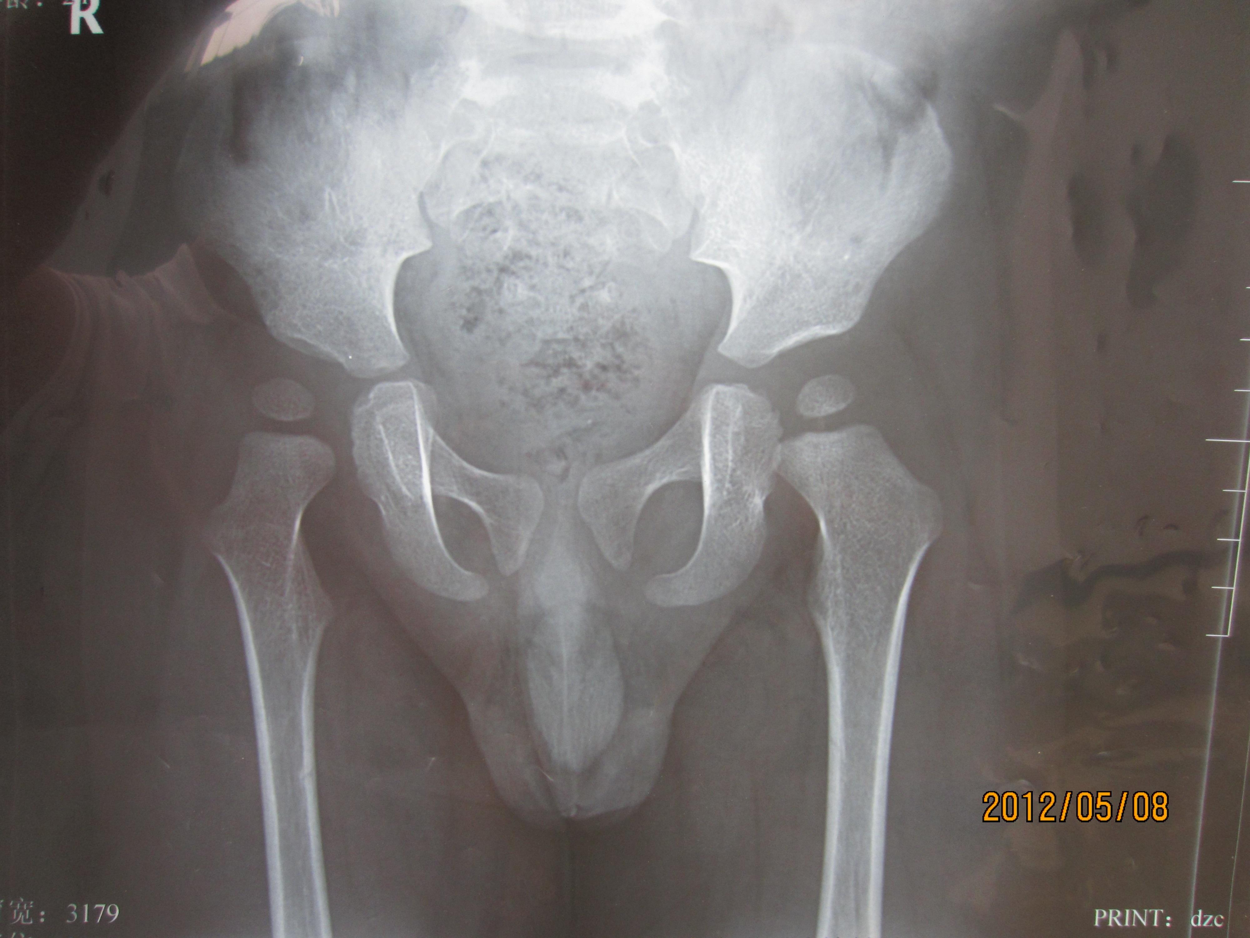 儿童骨盆x光图片