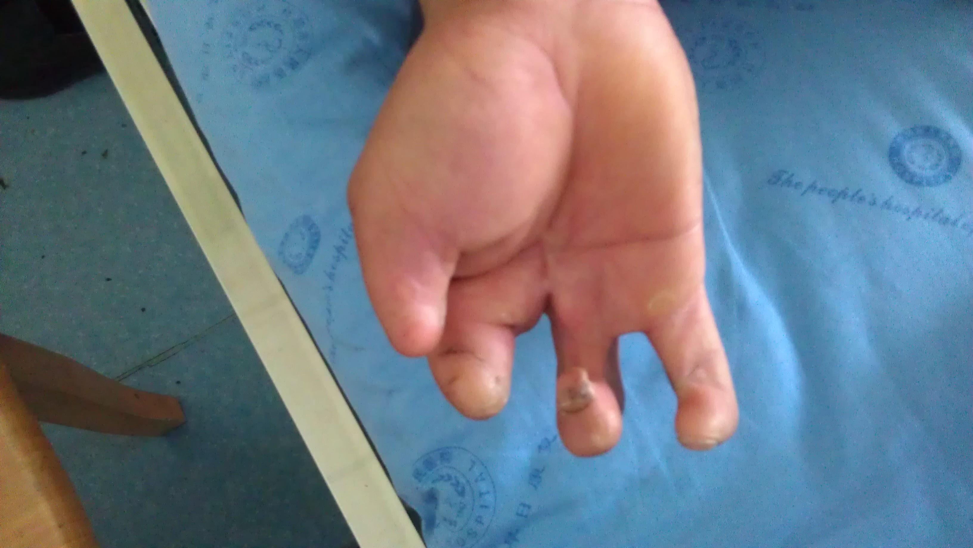 患者系男性 35岁 右手爆竹炸伤后30余年 目前部分手指缺损