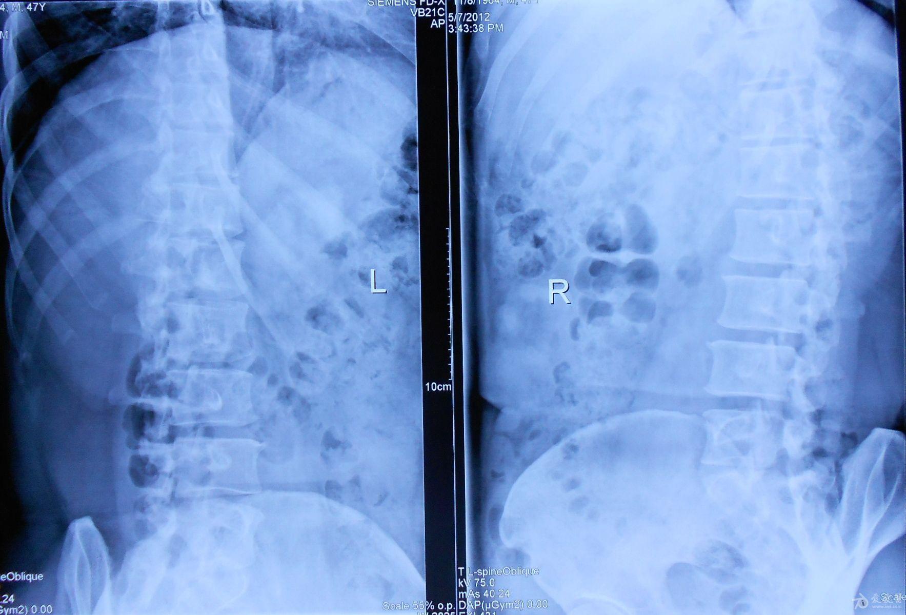 腰椎双斜位图片图片
