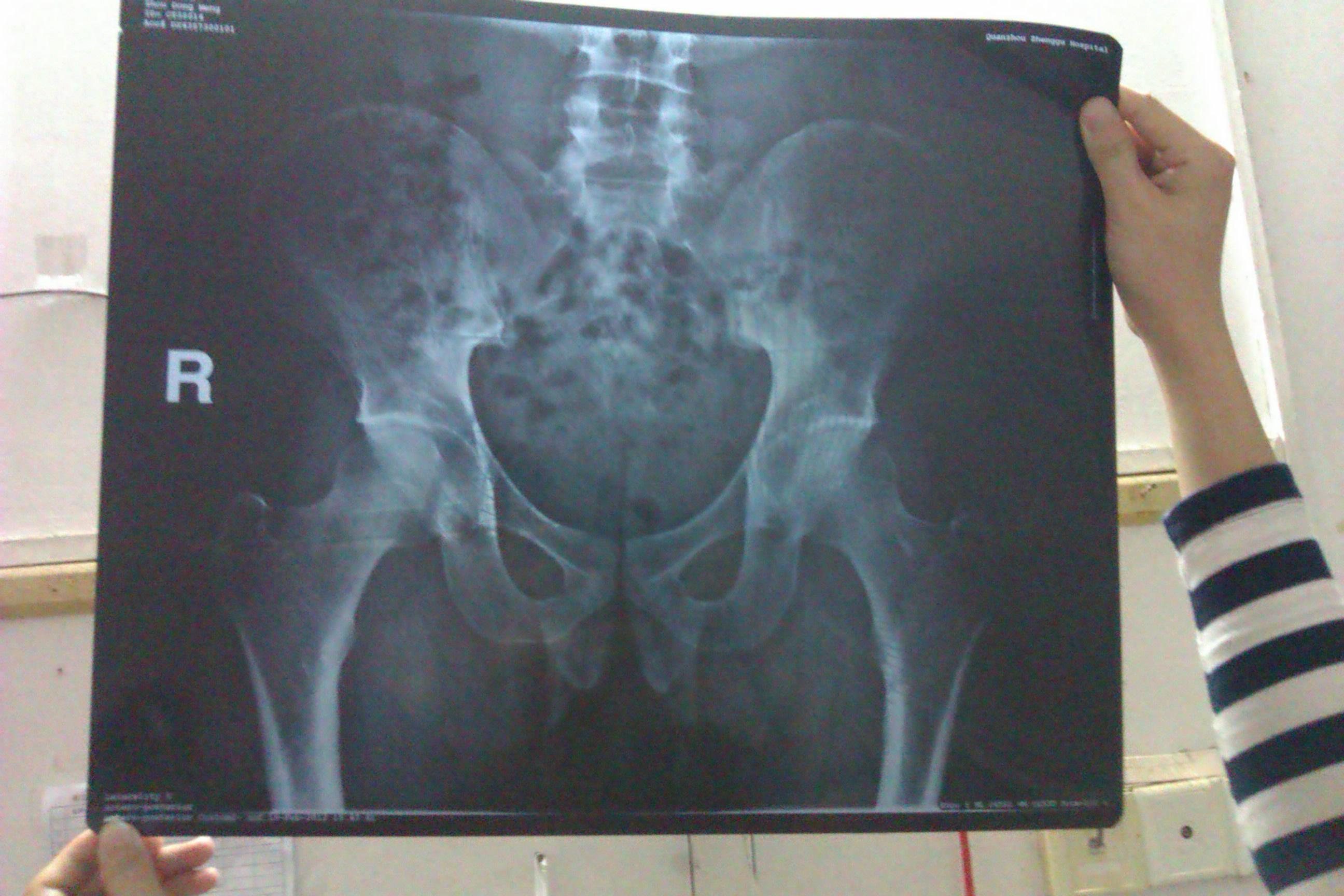 05-16 21:22:16核磁共振是03-14拍的;骨盆是02-12拍的;ct是01-10拍的