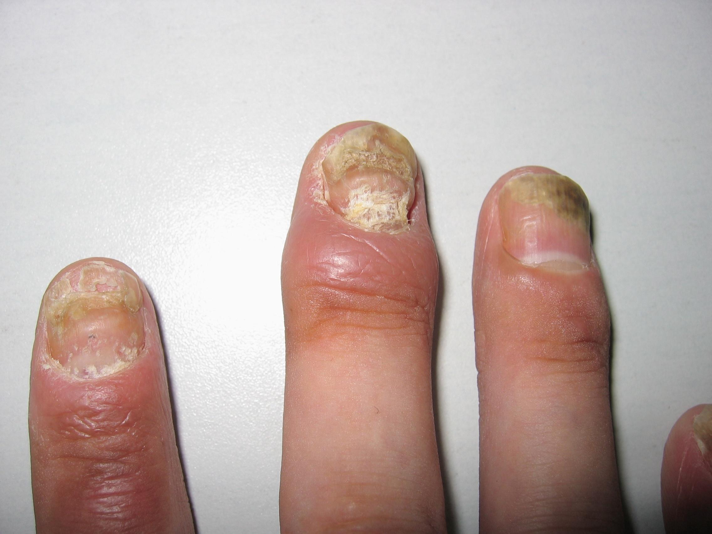 指甲银屑病图片 初期图片