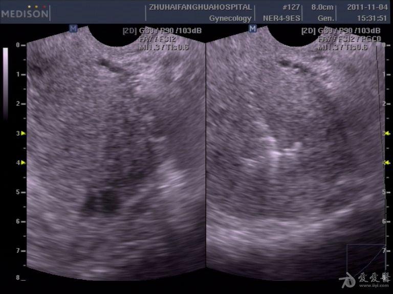 多姿多彩的宫内节育器 - 超声医学讨论版 - 爱爱医医学论坛 - 爱爱医