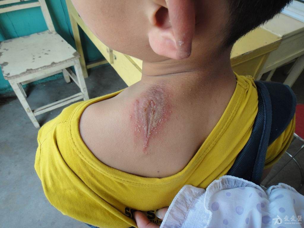 典型皮肤病之隐翅虫皮炎