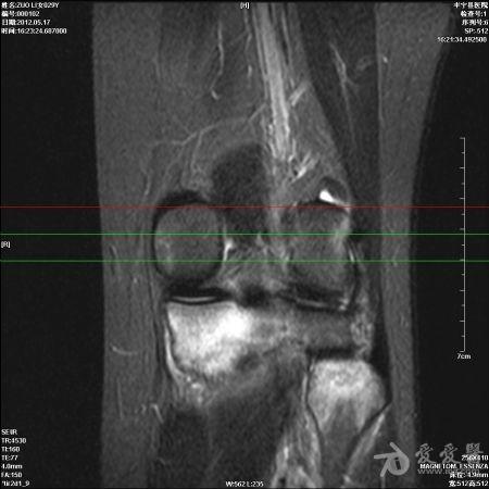 膝关节mri,骨挫伤