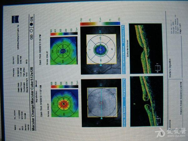 黄斑全层裂孔手术前后对比(通过oct) 