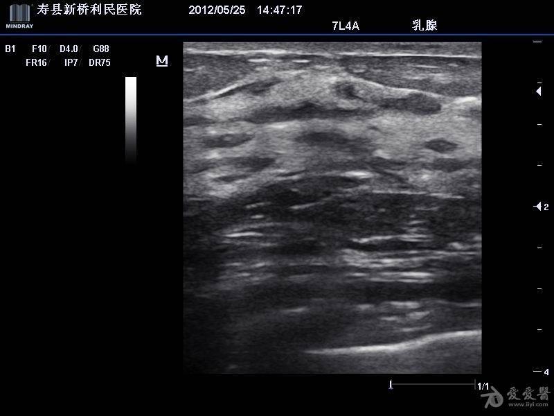 乳腺增生结节超声图像图片