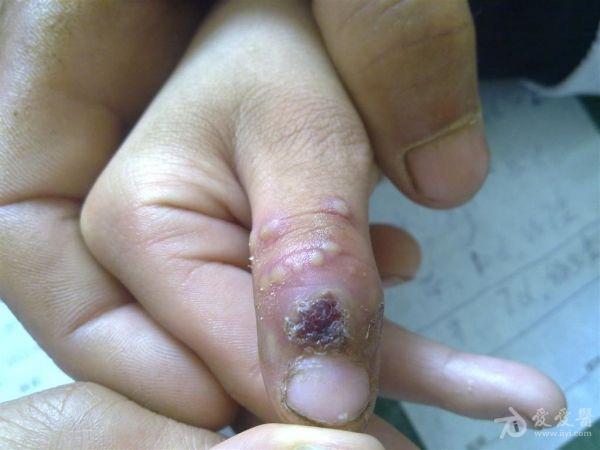 因右手拇指脓疱一周就诊,轻度疼痛