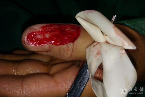 看看这个手外伤