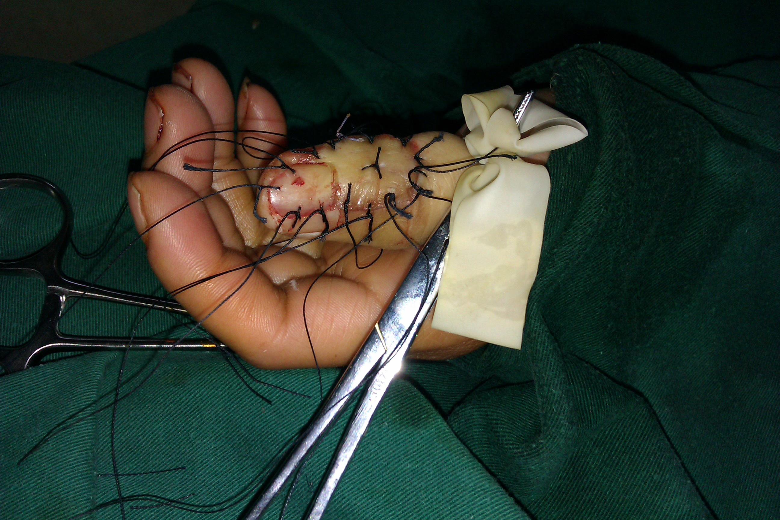 看看这个手外伤