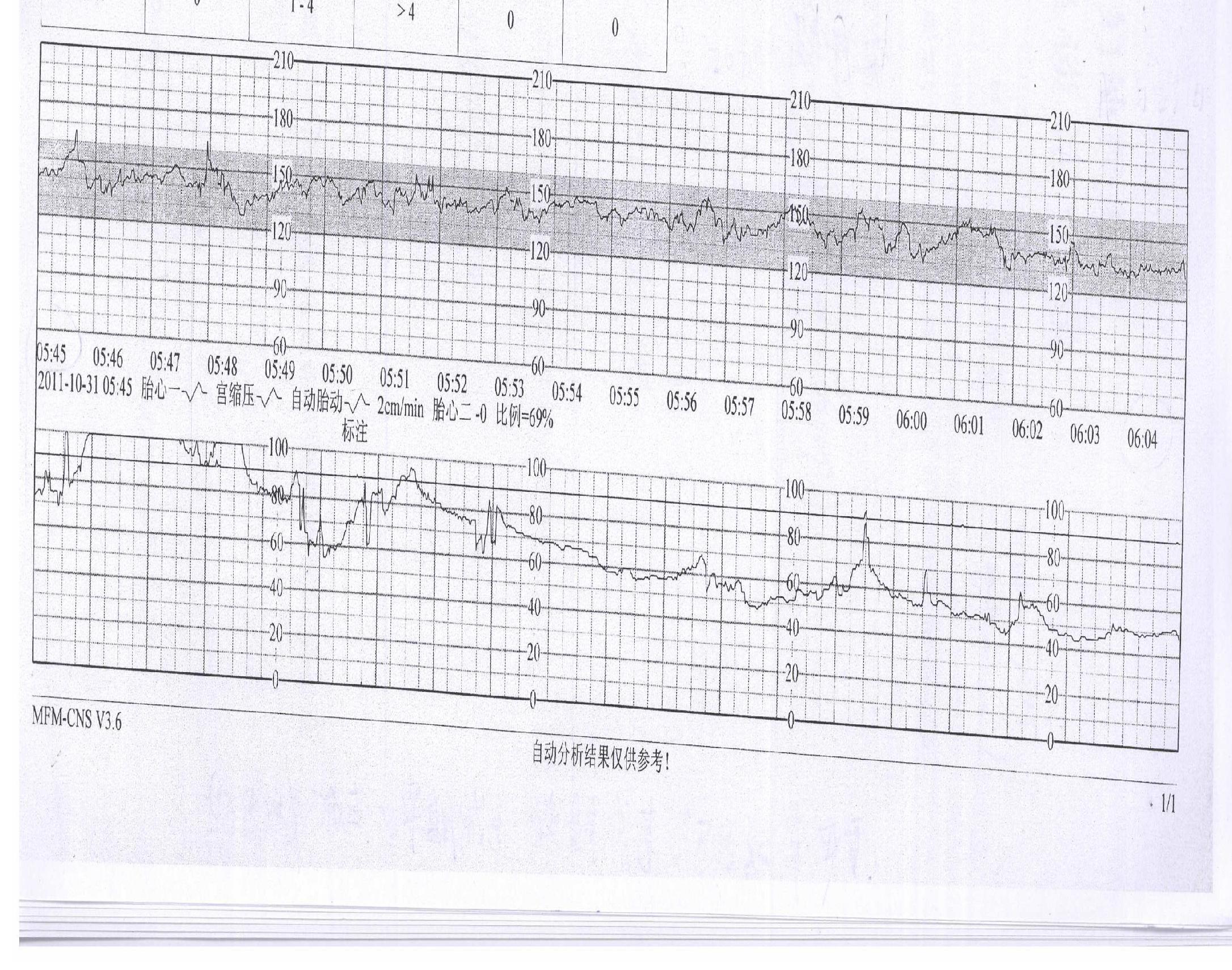 帮忙看一张胎心监护图