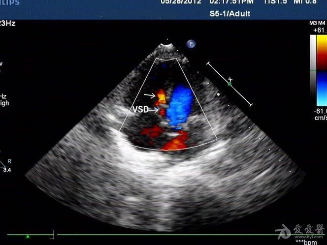 先心---室缺(膜部间隔瘤型)前后术后对比