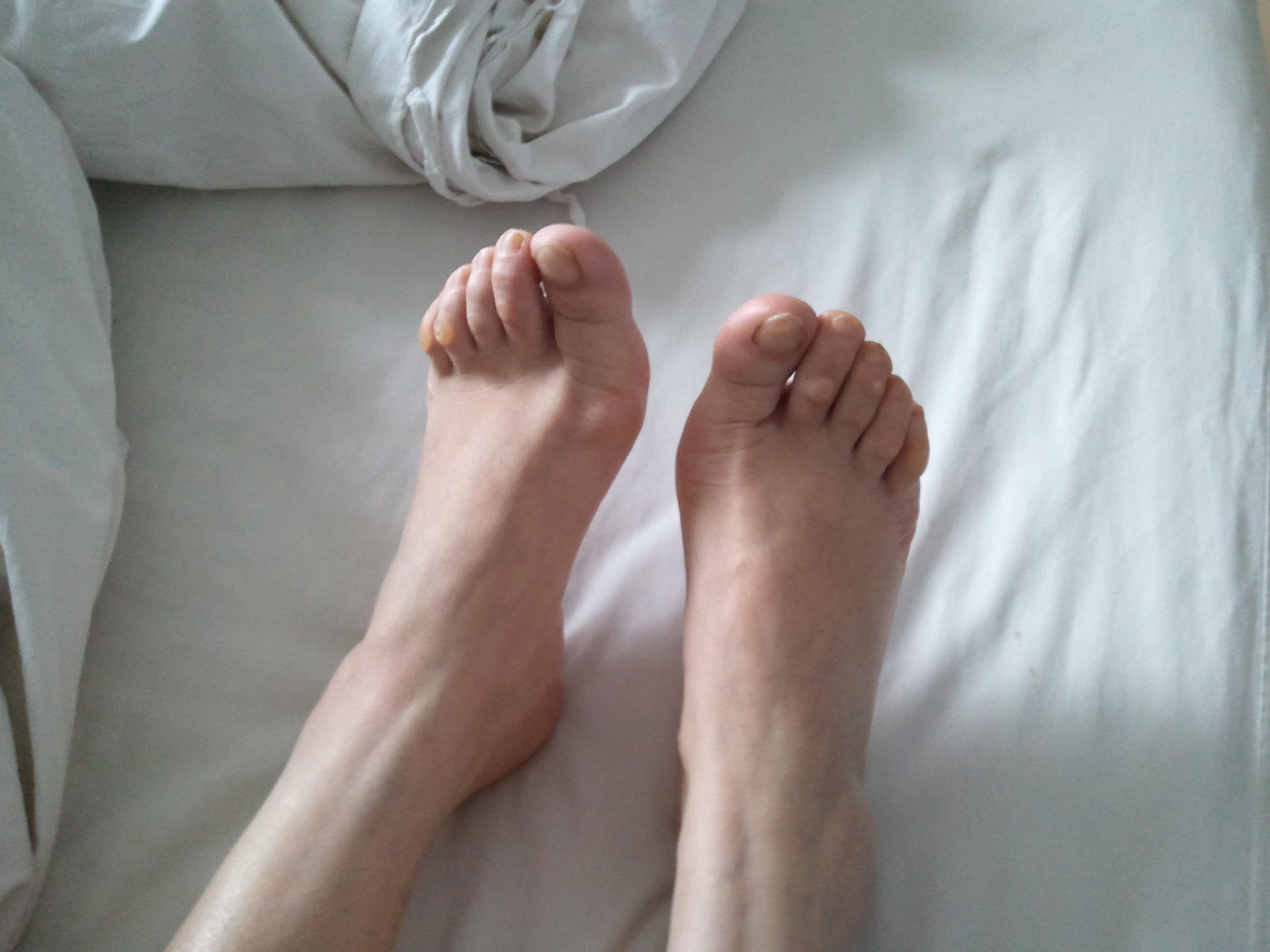 楼主中西医结合骨科2012-06-05 20:01:13   左足拇趾内侧疼痛5年.