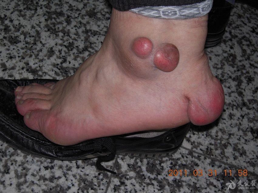 门诊遇到的病人——结节性黄瘤