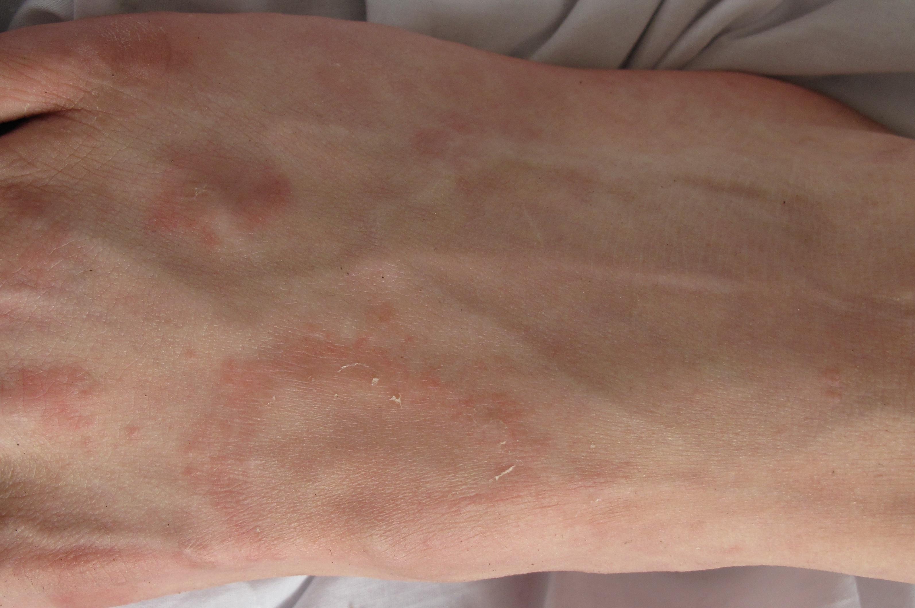 足背皮疹近二年 - 皮肤及性传播疾病讨论版 - 爱爱医医学论坛 - 爱爱