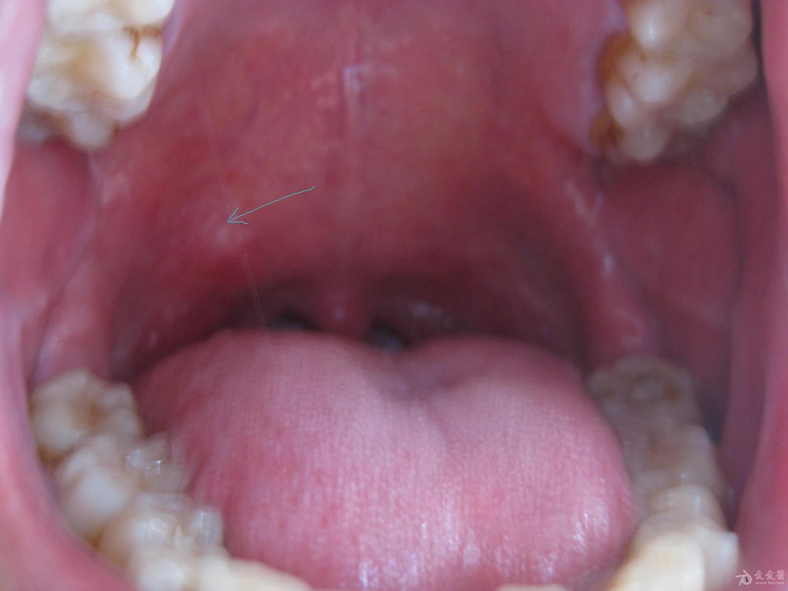 腭舌弓肿大图片