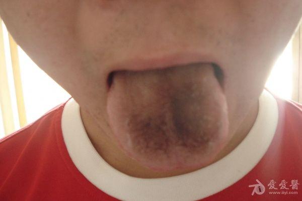 舌头灰褐色图片