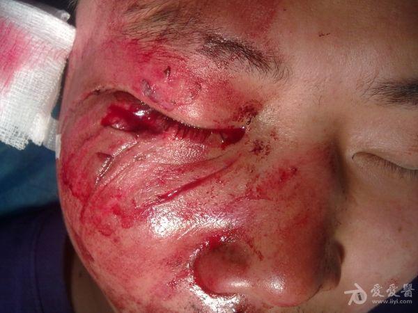 病人右侧面部大面积皮肤擦伤,肿胀,右眼下眼睑缘有断裂,并伴下睑皮肤