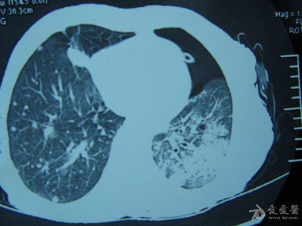肺癌胸腔积液闭式引流后产生气气胸治疗求助