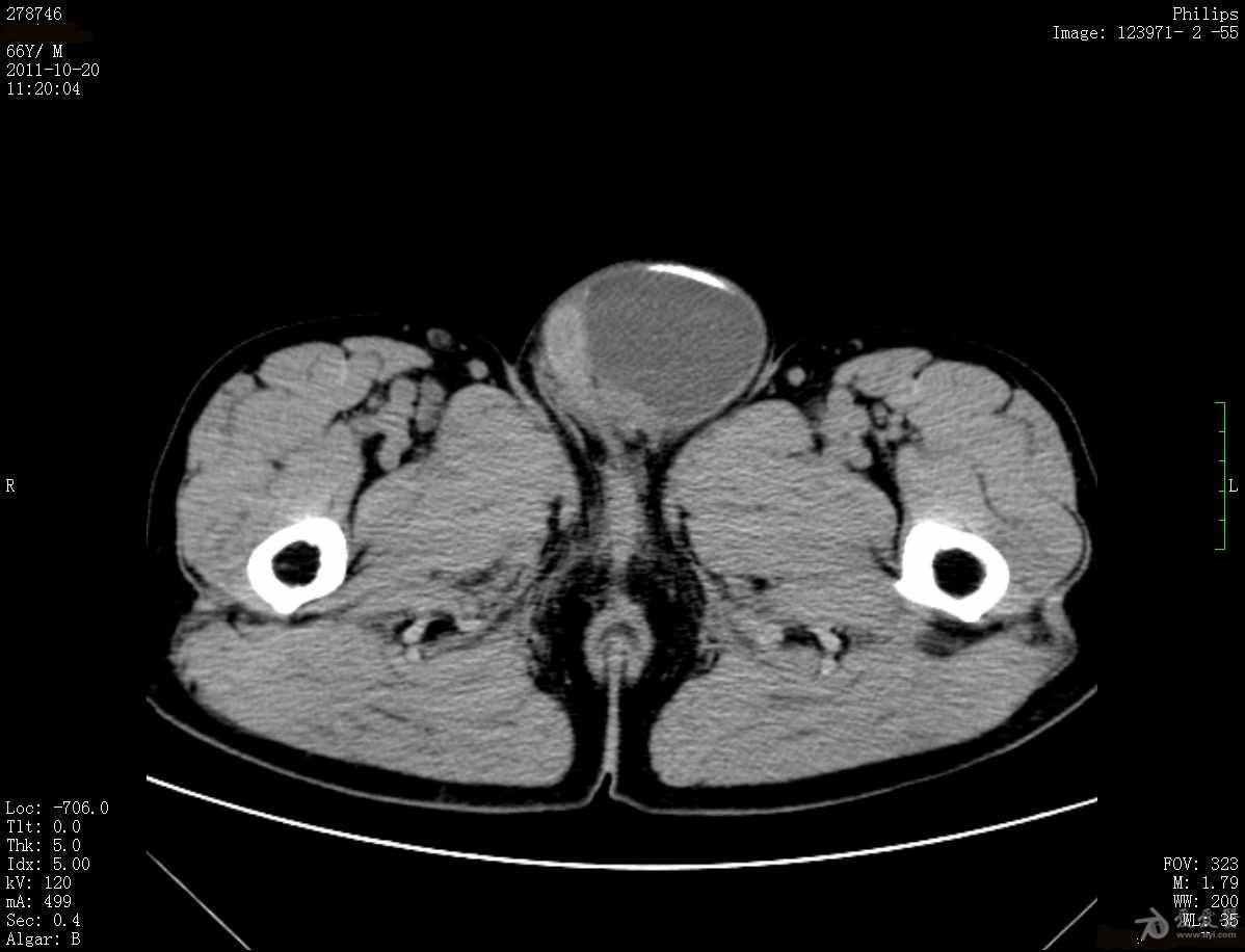 病例八:男性66歲,左下腹脹痛,陰囊腫物.(結果在8樓-神經源性膀胱)