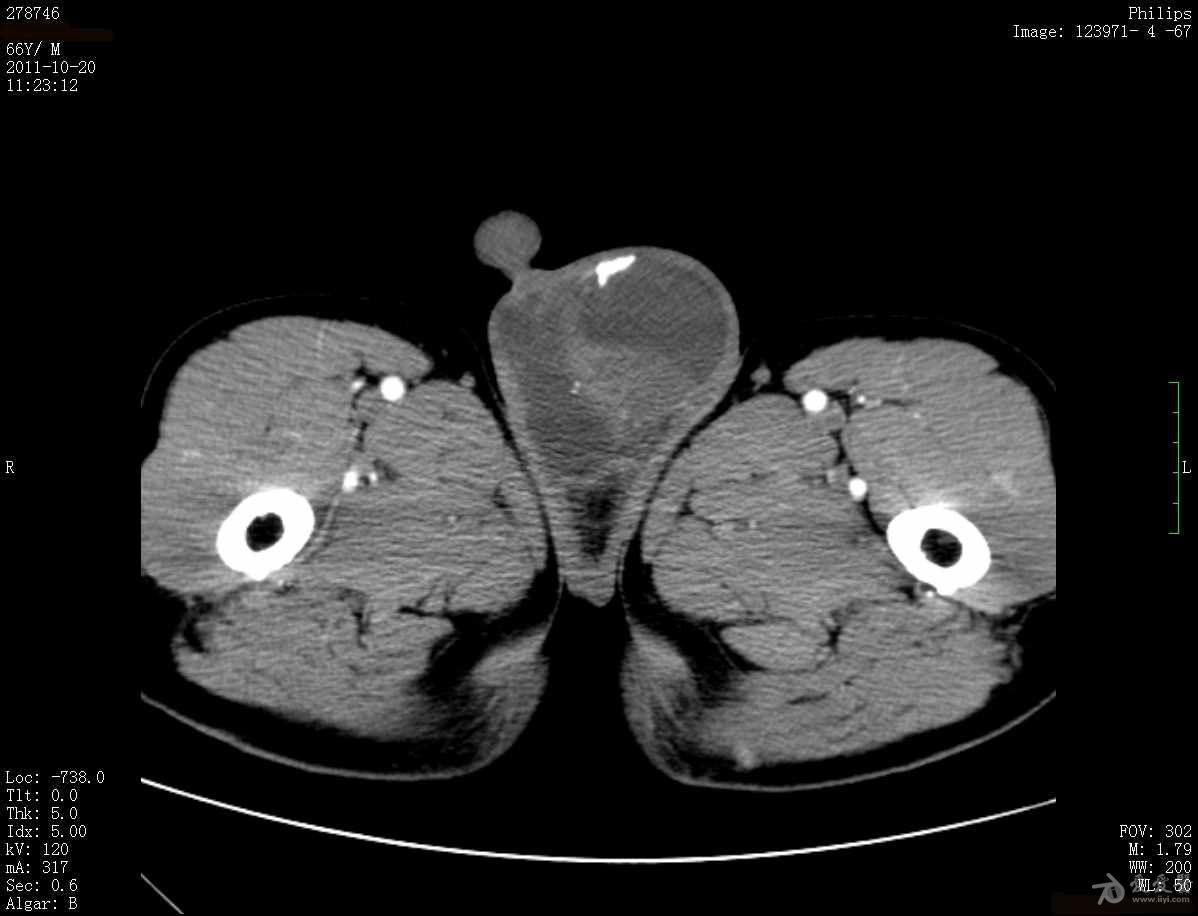 病例八:男性66歲,左下腹脹痛,陰囊腫物.(結果在8樓-神經源性膀胱)
