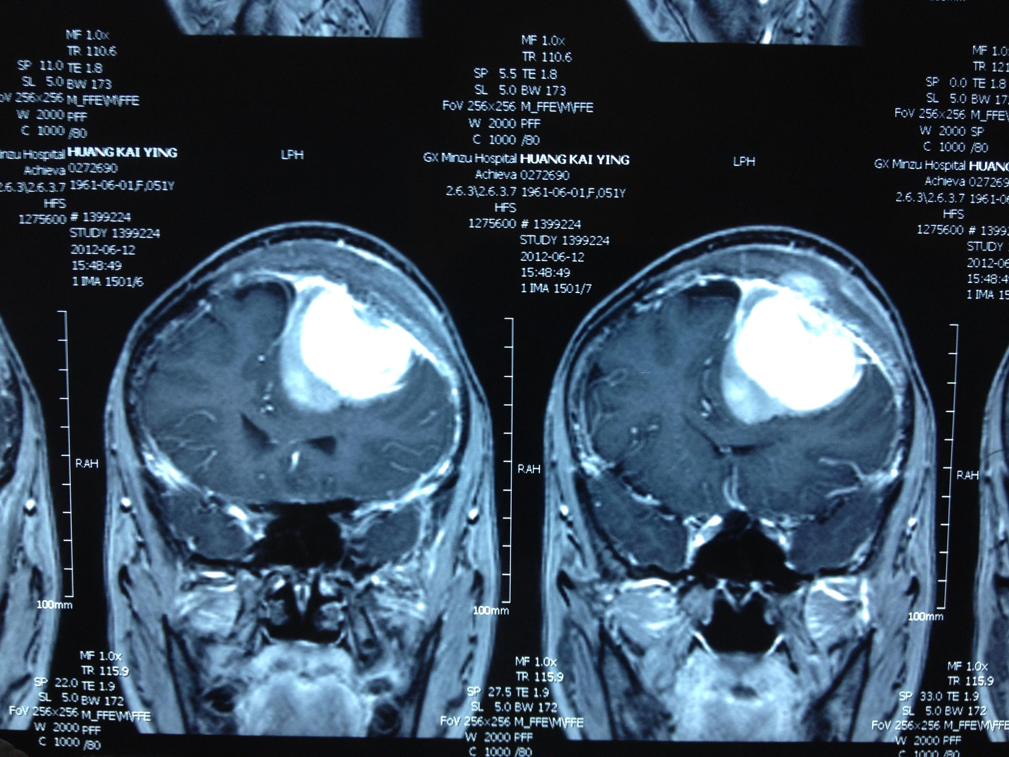 一例幕上脑膜瘤的手术探讨