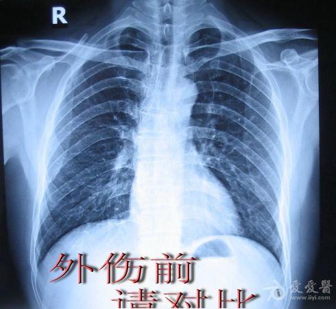 外伤性胸腔积液,治疗后如图示,请示治疗方案