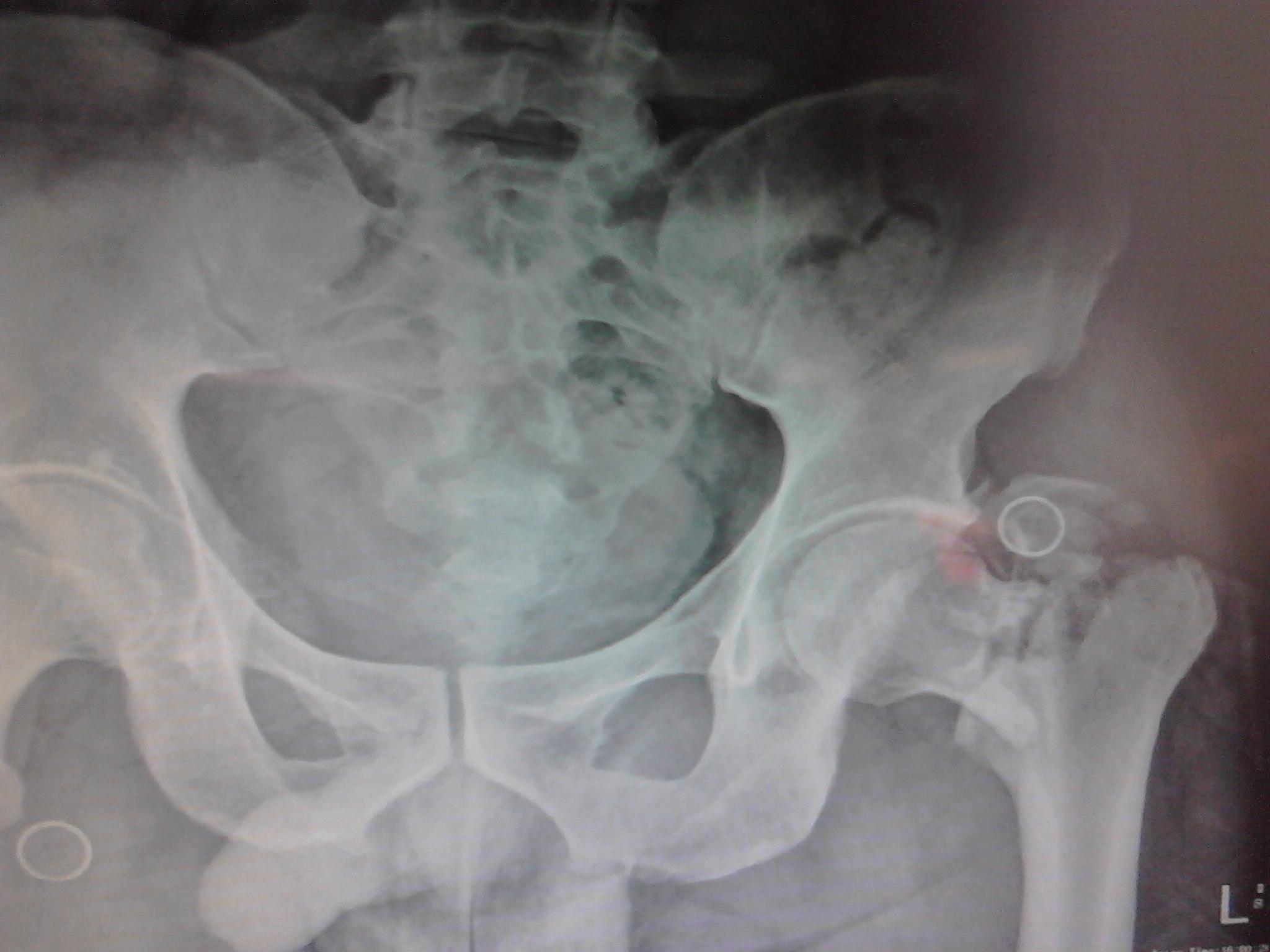 左股骨颈粉碎性骨折一例