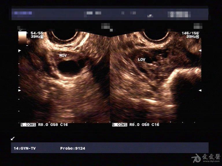 子宫内膜息肉典型声像.