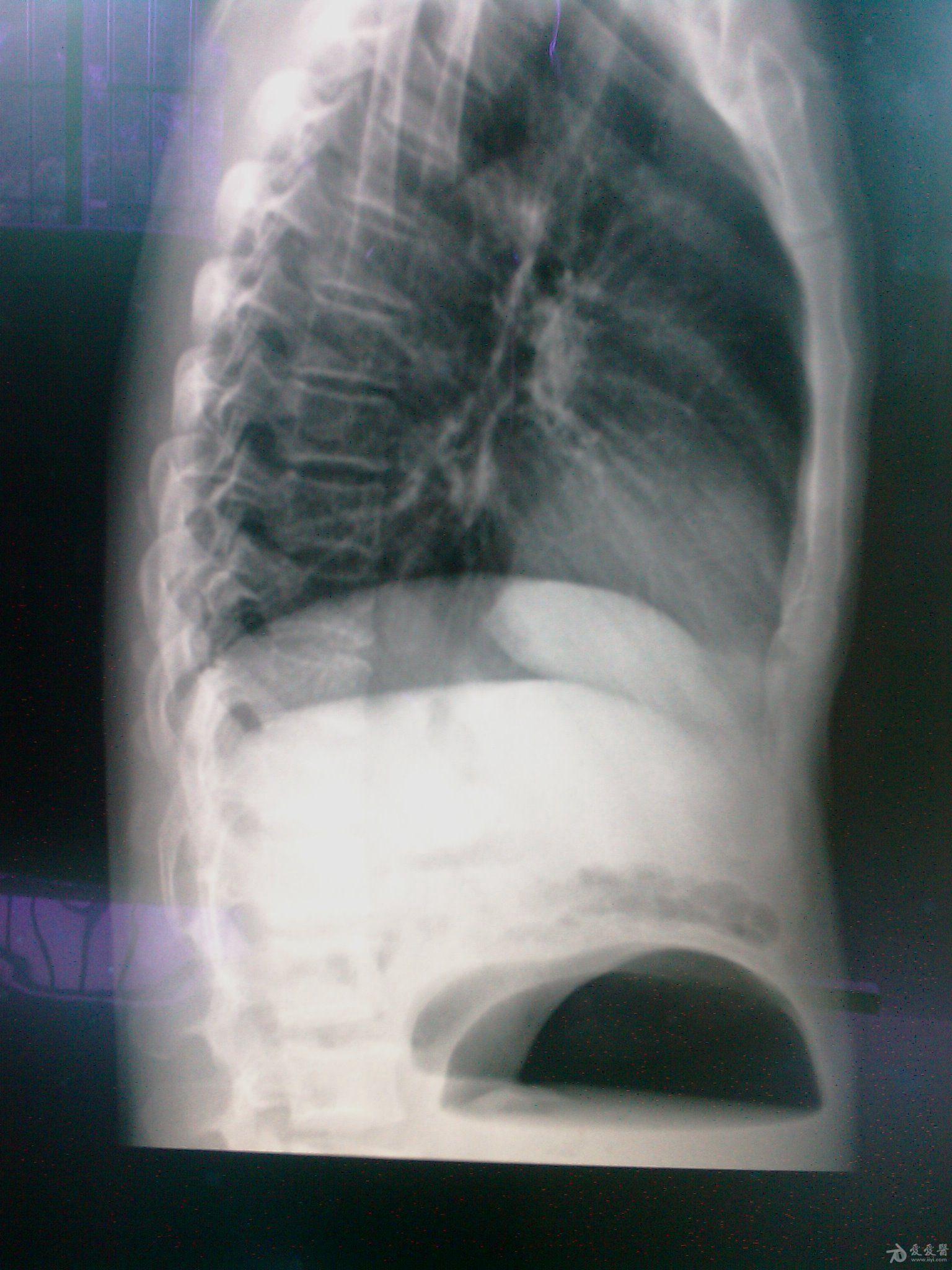 肠梗阻x线气液平面图图片