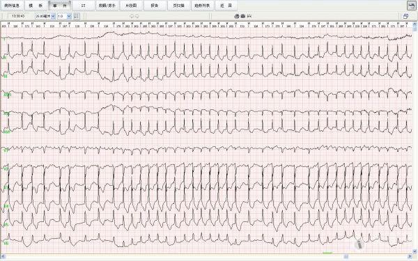 心脏房颤手术是重大疾病吗 房颤在保险公司疾病范围吗