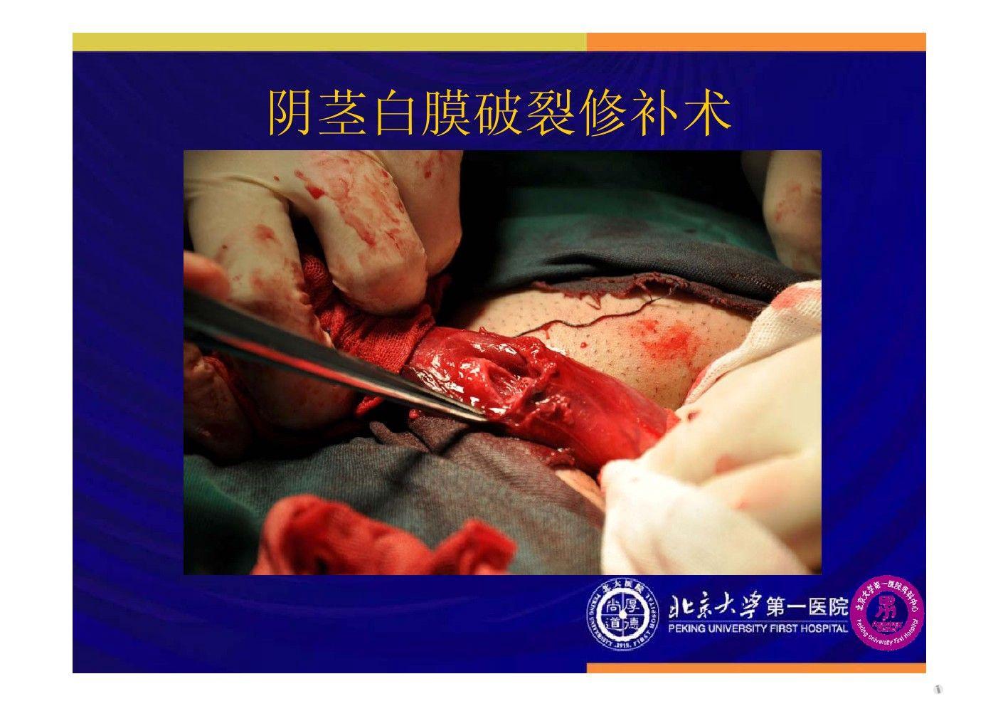 2012北京男科论坛(十六)——袁亦铭-男科手术的现状与治疗